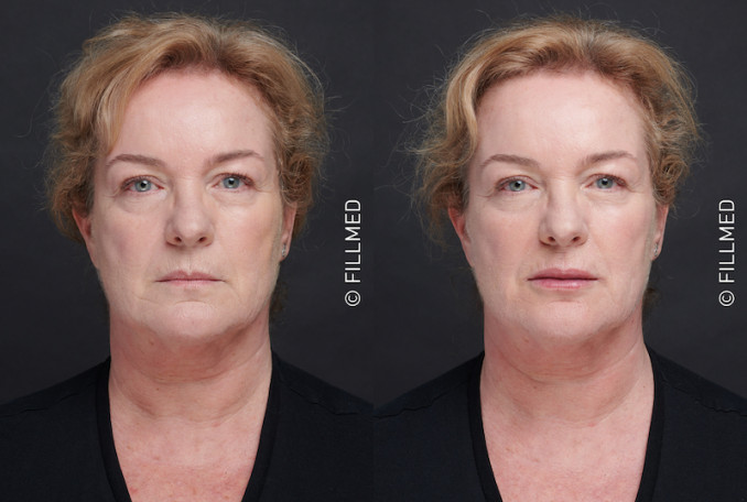 Prieš ir po lūpų korekcijos