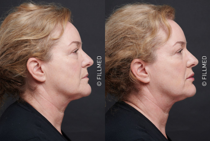 Prieš ir po lūpų korekcijos