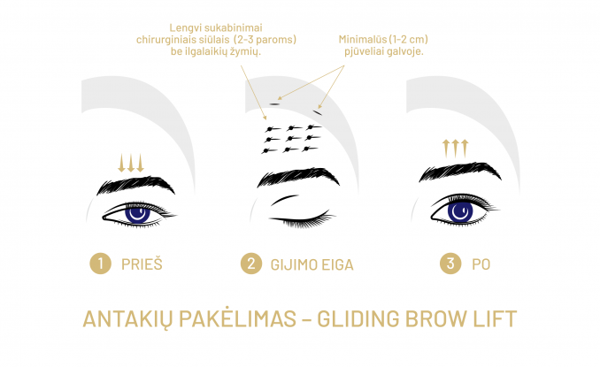 „Gliding Brow Lift“ – kai norisi natūralaus rezultato